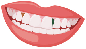 Info graphic of lips with a piece of good stuck in the teeth.